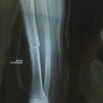 Uijtdebroeks souffre d’une fracture du radius après sa chute lors de la Volta a la Comunitat Valenciana 24 découvrez les informations essentielles sur la fracture du radius après une chute à volta, dans la communauté valenciana. symptômes, traitements et conseils pour une récupération optimale.