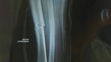 découvrez les informations essentielles sur la fracture du radius après une chute à volta, dans la communauté valenciana. symptômes, traitements et conseils pour une récupération optimale.