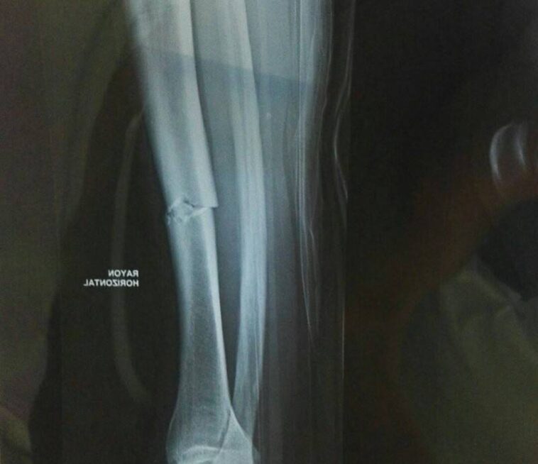 Uijtdebroeks souffre d’une fracture du radius après sa chute lors de la Volta a la Comunitat Valenciana 7 découvrez les informations essentielles sur la fracture du radius après une chute à volta, dans la communauté valenciana. symptômes, traitements et conseils pour une récupération optimale.